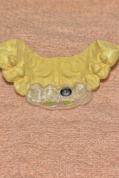 LUXURY CUSPIDS™ Brand Signature "Mirror of Pearls" Tooth Adornment Maxillary